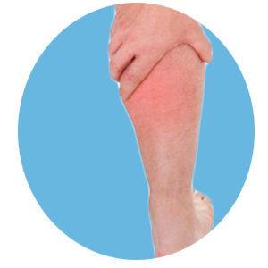 Leg Swelling Treatment