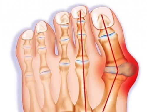 Bunion: Painful Lump At the Base of the Big Toe