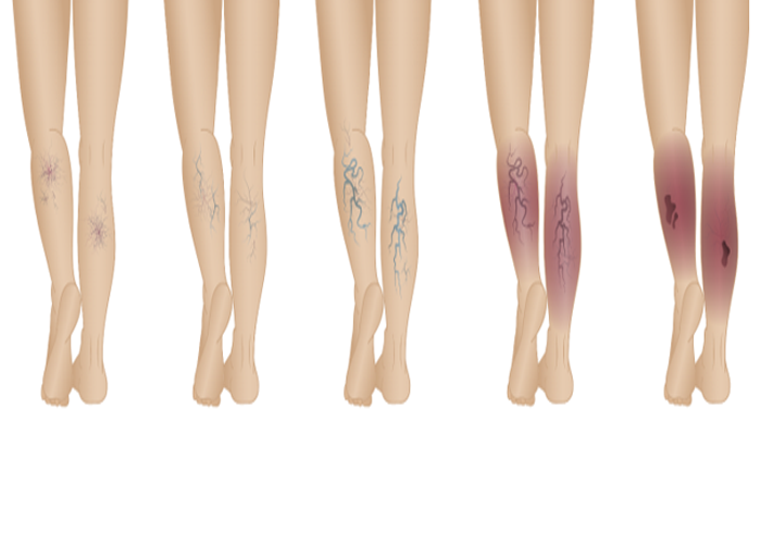 Vascular Issues And Compression Therapy