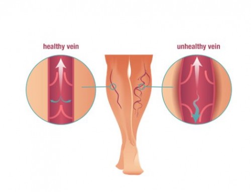 What Compression Stockings Can Do For You?